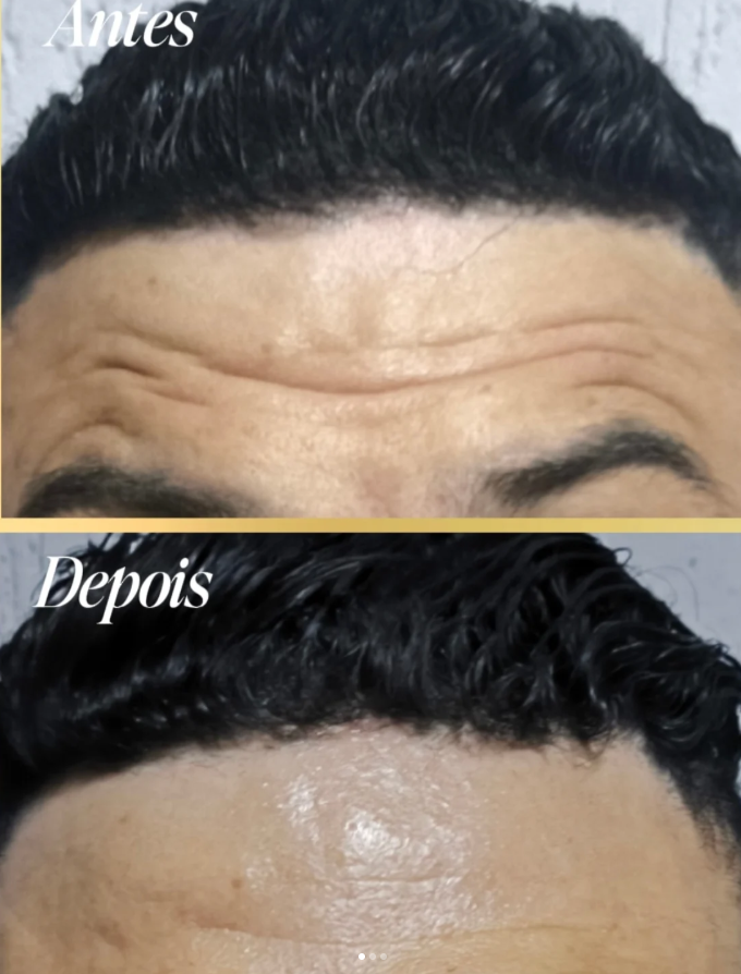 Antes e Depois - Estética Labial Morgana Guimarães