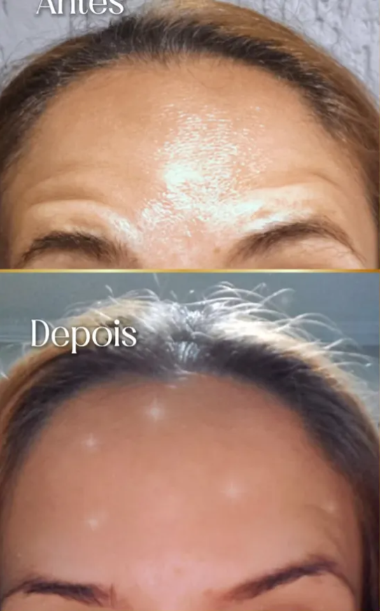 Antes e Depois - Suavização de Linhas de Expressão