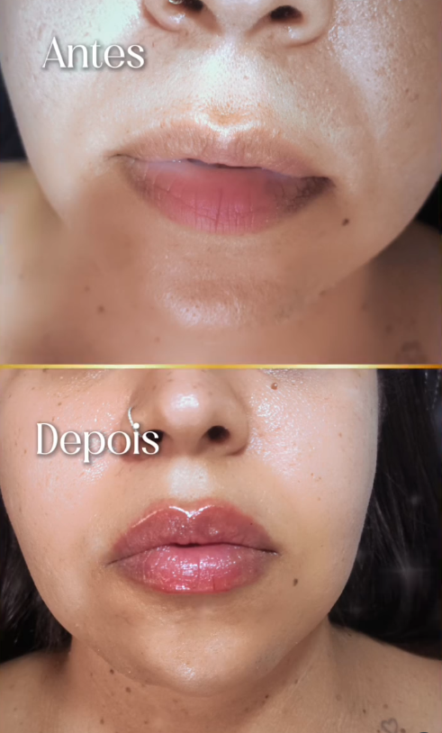 Antes e Depois - Tratamento Masculino Botox